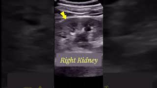 Tracing the Large  Obstructed Ureteric stone  Ultrasound [upl. by Assil]