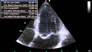 ACCURATE MEASUREMENT OF LVEF left ventricular ejection fraction by biplane simpsons method [upl. by Malina]