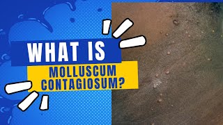 What is molluscum contagiosum [upl. by Inele455]