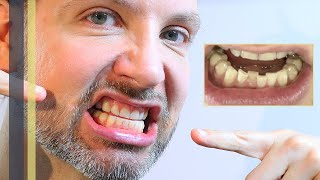 ZÄHNE WIEDER SCHIEF – NUR 2 JAHRE NACH DR SMILE  INVISALIGN ZAHNKORREKTUR – GREY YOUNG [upl. by Arihsan]