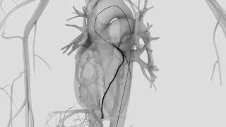 Asian Heart Hospital  How is Coronary Angiography Performed [upl. by Harte]