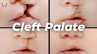 Why Cleft Palates Occur A Scientific Explanation [upl. by Nitsug]