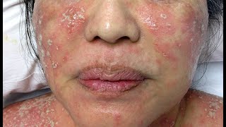 Managing Pustular Psoriasis on Your Face A Comprehensive Guide [upl. by Acinad]