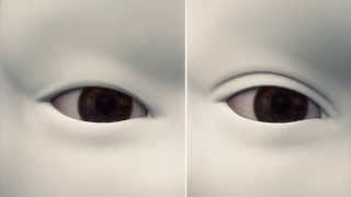 How double eyelid surgery works [upl. by Atimed]