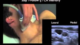 How to Supraclavicular Approach to Subclavian Vein Cannulation [upl. by Ati401]