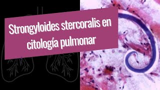 Strongyloides stercoralis en citología pulmonar [upl. by Ytrebil822]