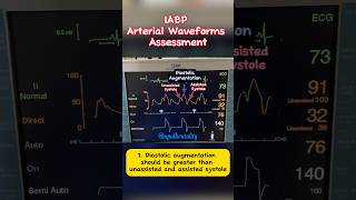 IABP Arterial Waveform Assessment cardiology criticalcare cathlab [upl. by Idou]