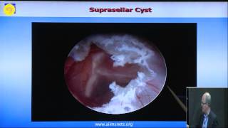 ETV and endoscopic intraventricular cyst management [upl. by Kaja]