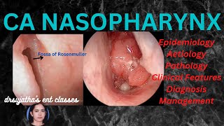 199Nasopharyngeal Carcinoma Part 13 epidemiology aetiologyclinical features nasopharynx [upl. by Aihseuqal592]