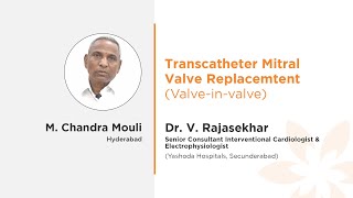 Transcatheter Mitral Valve Replacement ValveinValve Surgery  Mr Chandra Mouli [upl. by Hilten124]