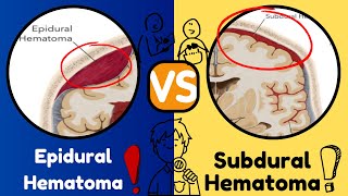 Extradural vs Subdural Hematomas  How do we Diagnose them on CT [upl. by Sibyls]