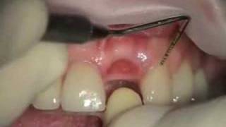 Transition to Implant Failing Upper Central [upl. by Lah]