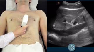 IVC Ultrasound  How to assess the IVC for volume status using ultrasound  Clarius Ultrasound [upl. by Llenrahc]