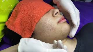 Loan Nguyen Acne Treatment 16511 [upl. by Eyatnod56]