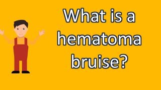 What is a hematoma bruise  Find Health Questions  Best Health TIPS [upl. by Saltsman]