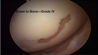 Knee Chondromalcia and Its Treatment [upl. by Ludmilla]