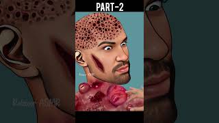 ASMR Treatment Warts amp Ance Animation Satisfying youtubeshorts shorts short asmranimation [upl. by Yelhak266]