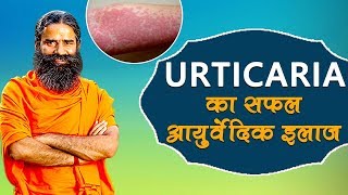 Ayurvedic Treatment Of Urticaria शीतपित्त  Swami Ramdev [upl. by Aihcropal276]