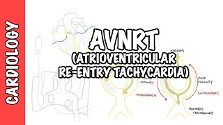 AVRNT atrioventricular reentry tachycardia  causes pathophysiology treatment [upl. by Emlyn]