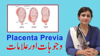 Placenta Previa Reasons amp Treatment  Dr Maryam Raana Gynaecologist [upl. by Lyon]