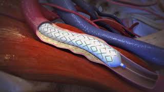 Peripheral Vascular Disease balloon stent by Gore Medical [upl. by Anitsrihc630]