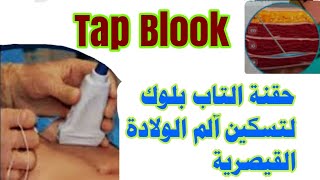 حقنة التاب بلوكTap Block لتسكين آلم الولادة القيصرية [upl. by Kit]