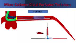 Micro Catheter Distal Perfusion Technique [upl. by Iphlgenia]