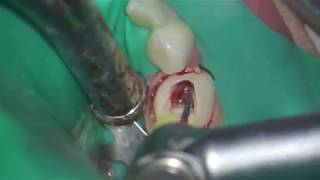 Pulpectomy with PediDent kids filesCMwire NiTi file [upl. by Notserc27]