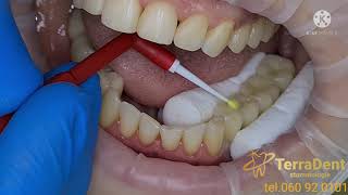 Stomatologie ChisinauBotanicaTerraDentCoroane dentare din Ceramica cu suport ZIRCONIU PE IMPLANT [upl. by Aray]