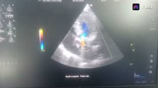 DEGENERATIVE CALCIFIC MODERATE AS MILD AR NORMAL LV DILATED LA [upl. by Cynthla228]