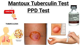 Mantoux Test  Tuberculin Skin Test  PPD Test  Purified protein derivative [upl. by Emmeline577]