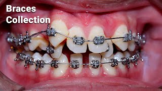 braces process collection [upl. by Sayette587]