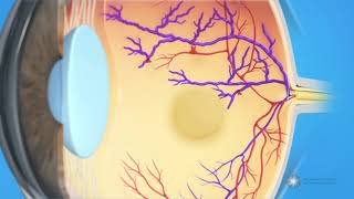 What is branch retinal vein occlusion BRVO [upl. by Essinger]