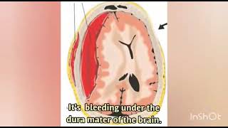 DECOMPRESSIVE CRANIECTOMY FOR SUBDURAL HEMATOMA [upl. by Iliam]