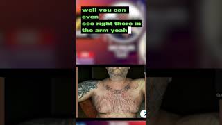 Episode 31 Lichenoid dermatitis scalp psoriasis and inverse psoriasis Part 2 prife testimonial [upl. by Issie]