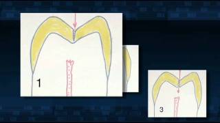 Dental Patient Education Sealants [upl. by Notxarb]