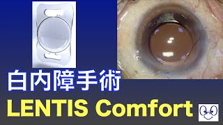 Cataract Surgery  LENTIS Comfort Implantation 白内障手術 レンティスコンフォート挿入 [upl. by Clark]