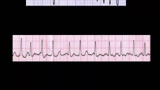 CURSO DE ELECTROCARDIOGRAFIA 24  AUTOEVALUACIÓN SOBRE MEDICIÓN DE FRECUENCIA [upl. by Enneyehs]