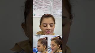 facelift  nose lift  chin augmentation after 9 days xuhuongyoutube lamdep thongthainguyen fyp [upl. by Nnod69]