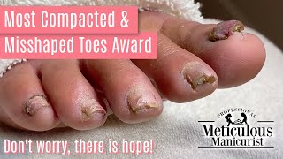 How to Pedicure Transformation the Most Compacted amp Misshapen Toenails [upl. by Averat]