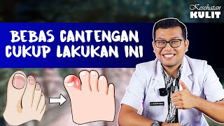 CARA MUDAH MENCEGAH CANTENGAN  DOKTER SADDAM ISMAIL [upl. by Cyndi]