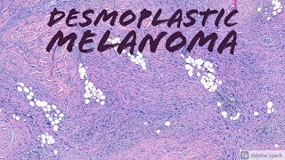 Desmoplastic Melanoma vs Scar vs Neurofibroma Dermpath Pathology Dermatology [upl. by Ellezig]