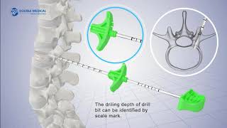 PKP Percutaneous Kyphoplasty System PKP [upl. by Pandolfi289]