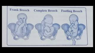 Breech presentation  obg  bsc nursing gnm  obg [upl. by Merriman]