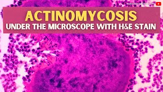 Actinomycosis under the microscope with Haematoxylin and Eosin HampE stain [upl. by Alegnasor]