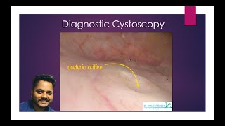 17 Diagnostic Cystoscopy Voiceover SEE WHAT A BLADDER LOOKS LIKE FROM THE INSIDE [upl. by Samtsirhc]