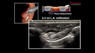 ULTRASOUND GUIDED INTERCOSTAL NERVE BLOCK [upl. by Dennet775]