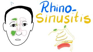 Rhinosinusitis Acuteamp Chronic Clinical Picture Diagnosisamp Management  Cases [upl. by Cuda100]