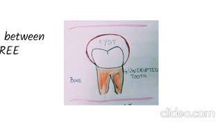 Dentigerous Cyst  Pathogenesis [upl. by Secrest]