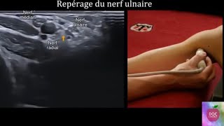 Echographie du nerf ulnaire cubital [upl. by Beverlie664]